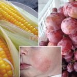 Jangan Ambil Mudah, Ini Dia 12 Sayur & Buah Yang Bahaya Untuk Ekzema