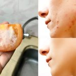 Wanita Kongsi Petua Tomato Ais Untuk Hilangkan Jerawat, Hasilnya Luar biasa & Kulit Jadi Cantik!