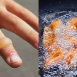 Petua Jika Terkena Minyak Panas Ketika Memasak, Ini Langkah Pertama WAJIB Buat!