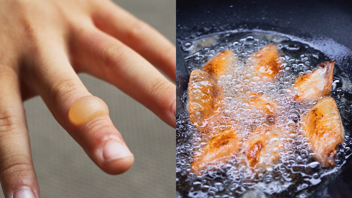 Petua Jika Terkena Minyak Panas Ketika Memasak, Ini Langkah Pertama WAJIB Buat!